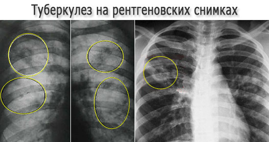 Туберкулез легких на рентгеновских снимках