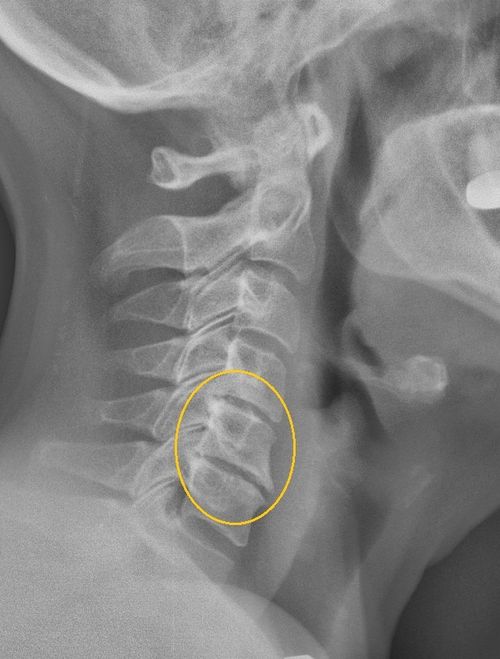 Шейный остеохондроз на рентгеновском снимке