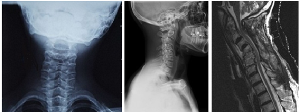 Диагностику шейного кифоза проводят с помощью рентгенографии, КТ или МРТ