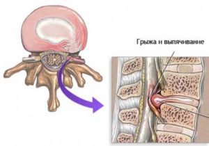 Укрепление мышц спины в грудном отделе позвоночника thumbnail