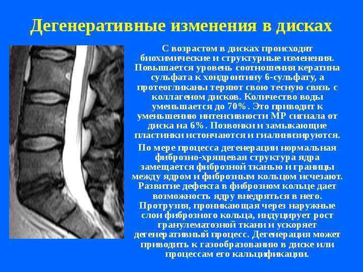 Mp картина дегенеративно дистрофических изменений пояснично крестцового отдела позвоночника