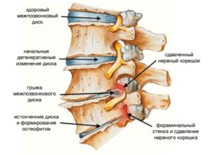 Боль в спине грудной отдел позвоночника упражнения thumbnail