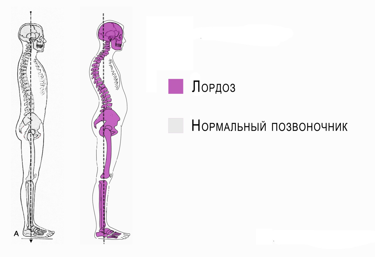 На рисунке отражено заболевание которое называется дистрофия патологический лордоз сколиоз впр
