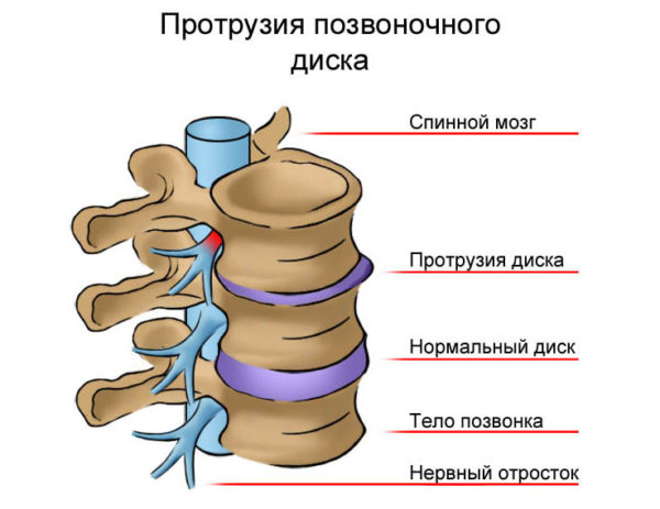 Протрузия может вызвать температуру