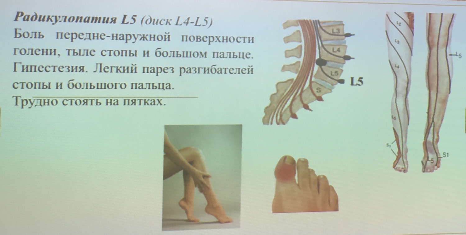 Радикулопатия l5 s1. Радикулопатия s1 корешка. Радикулопатия s1 Корешков. Радикулопатия Корешков л5. Радикулопатия л4-5.