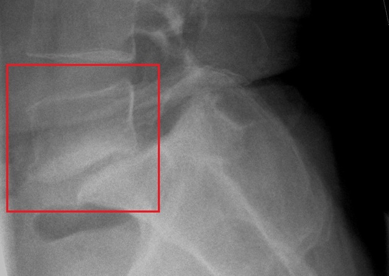 Антелистез позвонка. Ретролистез l5 позвонка рентген. Антелистез l4 рентген. Антелистез l3 позвонка что это такое. Антелистез l5 рентген.