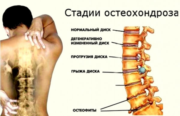 Стадии остеохондроза