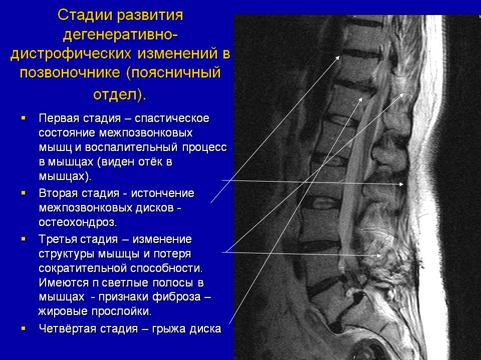 Мр картина дегенеративно дистрофических изменений пояснично крестцового отдела