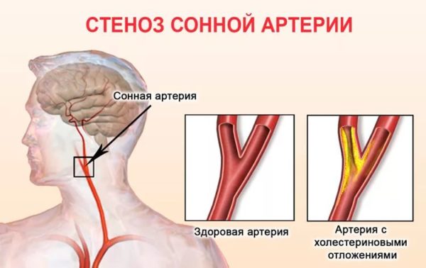 Кровеносные сосуды шейного отдела позвоночника thumbnail