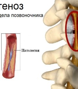 Сужение артерии в шейном отделе