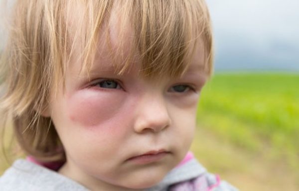 Чем сбивать температуру у ребенка после прививки акдс и полиомиелит thumbnail