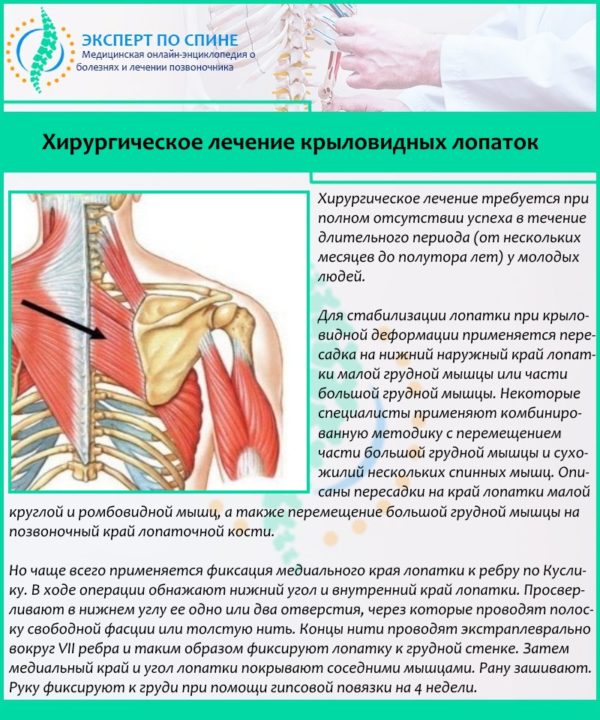 Хирургическое лечение крыловидных лопаток