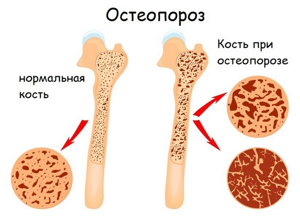 Выделяют несколько основных причин развития остеопороза