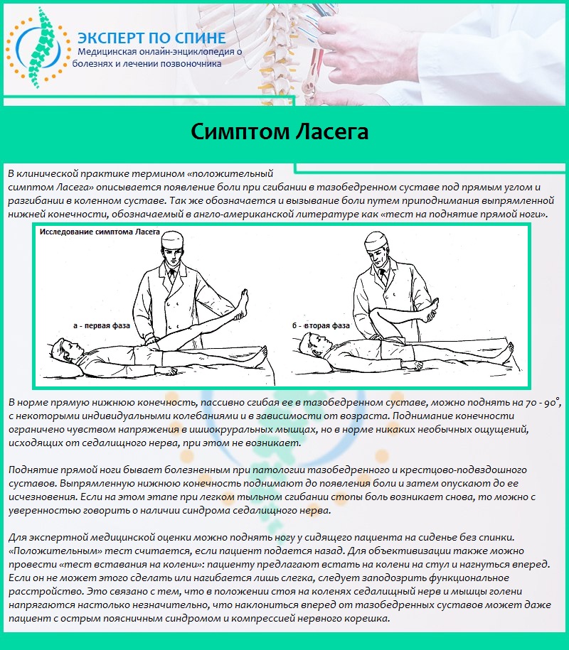Поднять больного. Симптом натяжения Ласега. Симптом Ласега в неврологии. Положительный симптом Ласега.