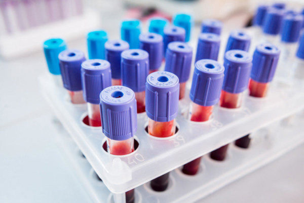 Биохимический анализ крови является простым и информативным методом первичной диагностики широкого спектра патологий