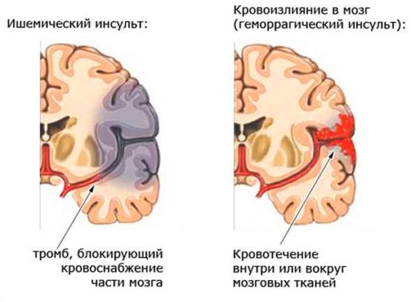 Ишемический инсульт, кровоизлияние в мозг