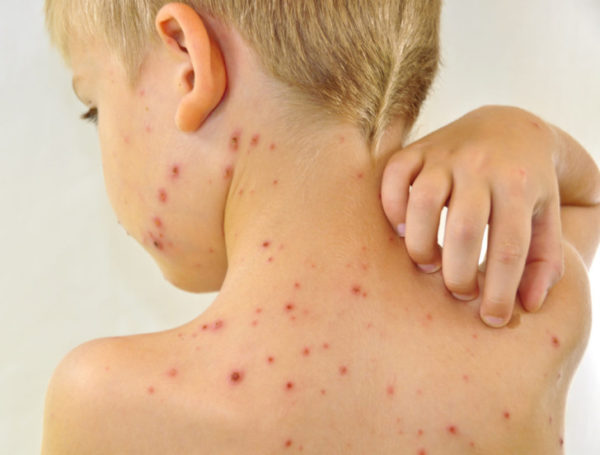 Существует много причин появления сыпи и прыщей на коже спины
