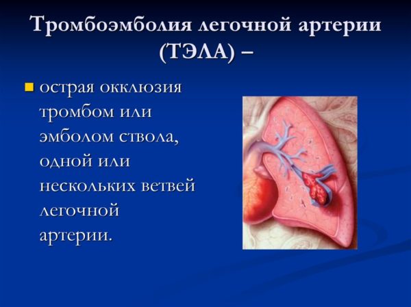 Тромбоэмболия легочной артерии 