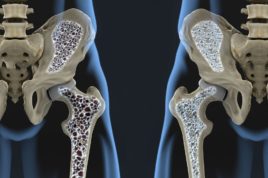 Обе патологии характеризуются уменьшением плотности костной массы, что потенциально опасно повышенной хрупкостью костей и склонностью к переломам