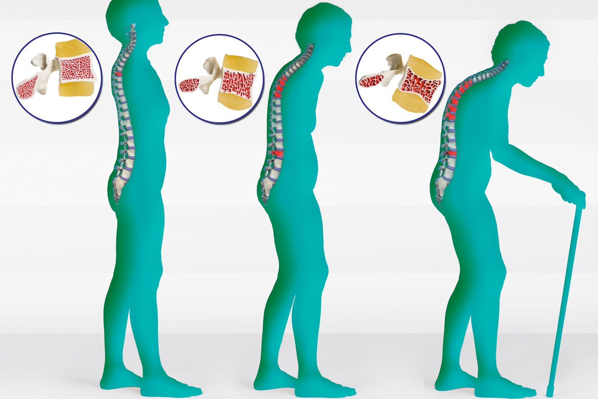 Остеопороз картинки фото