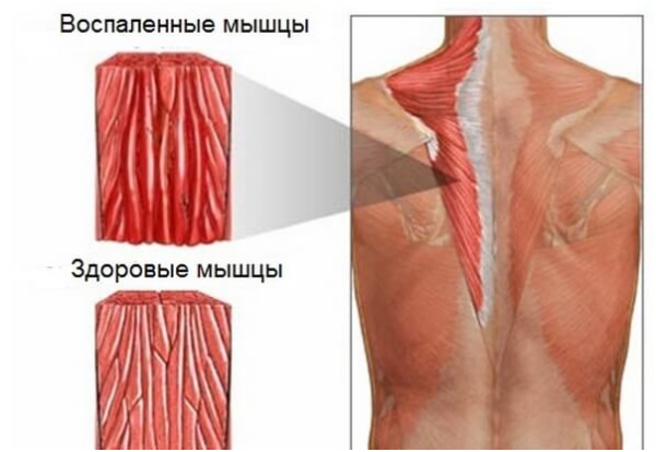 Воспаленные мышцы при миозите