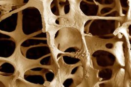 Диффузный остеопороз