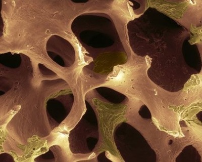 Пористость костной ткани - основной признак остеопороза на рентгене