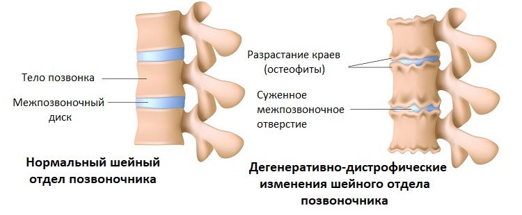 Мр картина дегенеративных изменений пояснично крестцового отдела