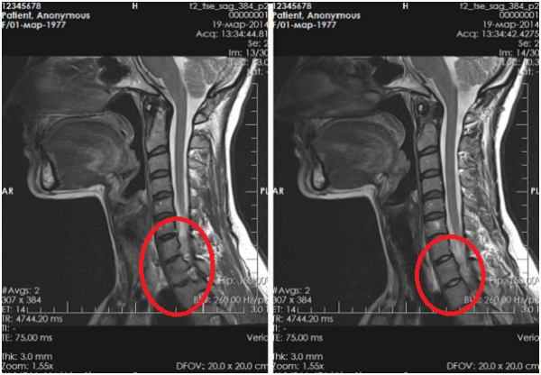 Выявление дегенеративно-дистрофических изменений в шейном отделе позвоночника с помощью МРТ